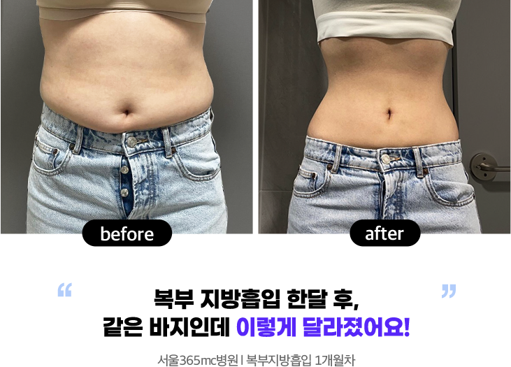 복부 지방흡입 한달 후, 같은 바지인데 이렇게 달라졌어요! 서울병원 l 복부지방흡입 1개월차