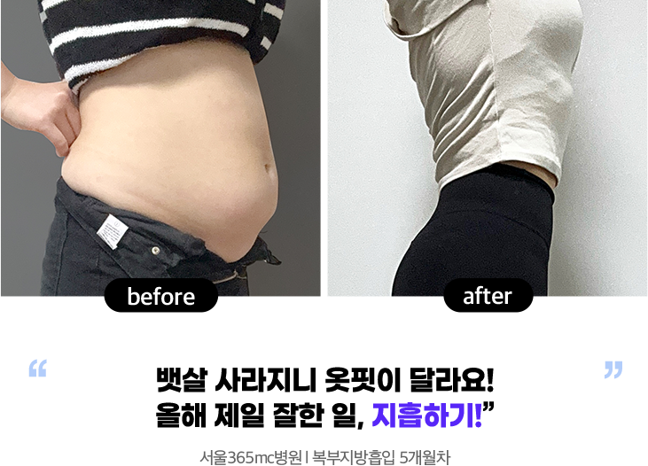 지방흡입 후, 무려 -10cm이상 줄어드는 기적! 식이조절 더욱 열심히 해서 크롭티 도전할거에요! 대구점 l 복부지방흡입 6주차