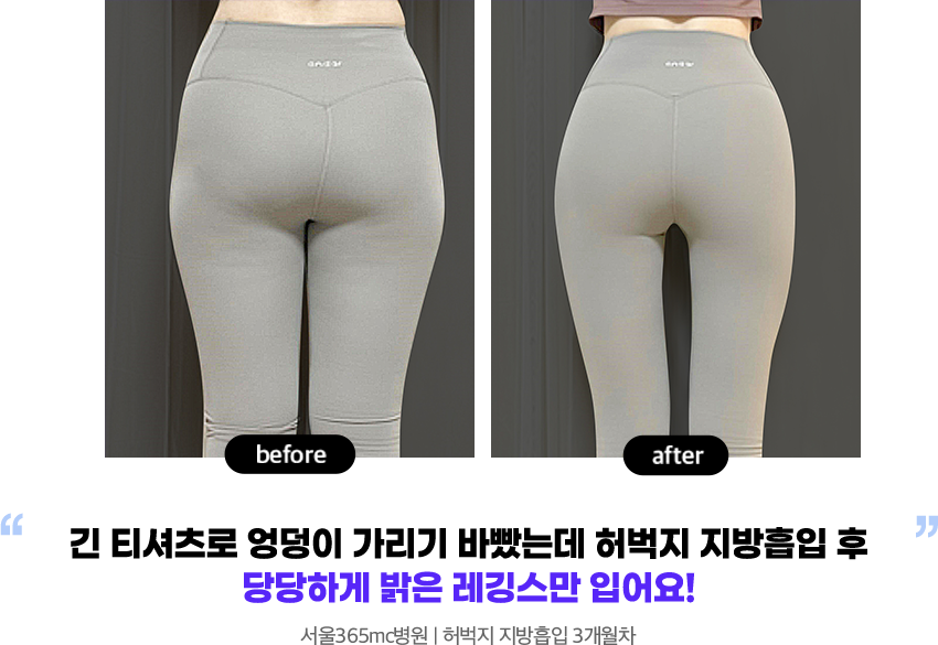 운동으로는 빠지지않던 하체비만... 마지막 희망이었던 지흡, 정말 원하던 대로 되었어요. 서울병원 l 허벅지 지방흡입 3개월차