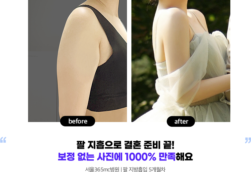 고민부위였던 팔 지흡으로 콤플렉스 해결하고 체중 감량하면서 전체적으로 라인도 정리되었어요! 서울병원 l 팔 지방흡입 5개월차