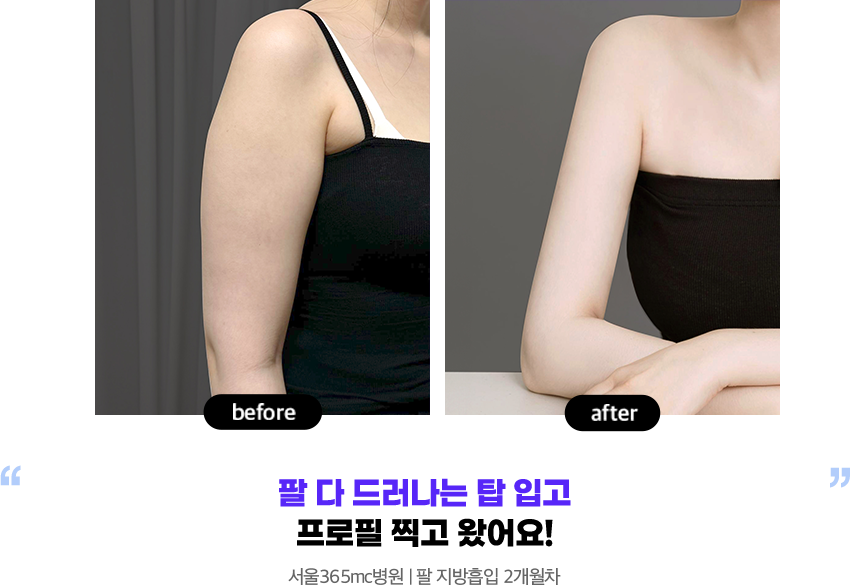 슬림해진 팔로 시원하게 민소매 도전! 부산병원 l 팔 지방흡입 4개월차