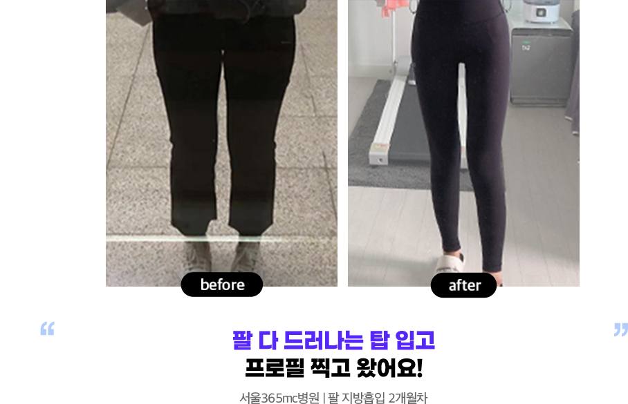이젠 전신거울 속 내 레깅스 핏 완벽해요! 서울병원 l 허벅지, 종아리 지방흡입 7개월차